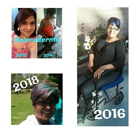 Meet your Posher, Scleroderma - Picture 1 of 1